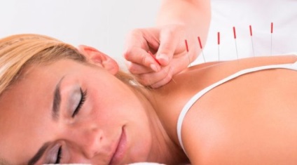 Acupunctura (acupunctura) cu osteocondroza ceea ce este si tratamentul