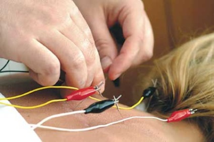 Acupunctura cu tratament herniated coloanei vertebrale, prevenire, recenzii