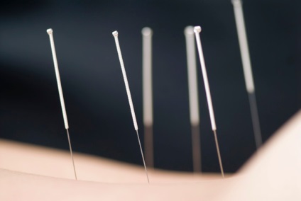 Acupunctura cu tratament herniated coloanei vertebrale, prevenire, recenzii