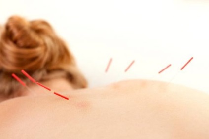 Acupunctura pentru osteocondroza cervicală