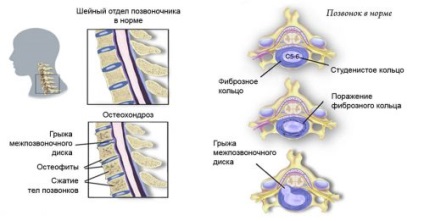 Acupunctura pentru osteocondroza cervicală