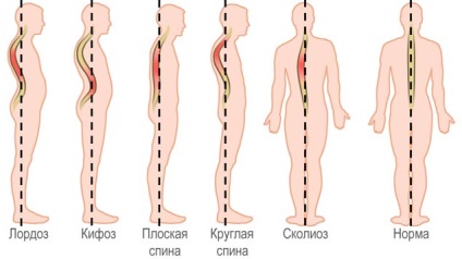 Curbură a coloanei vertebrale, varietățile sale, simptome și metode de tratament în rețeaua de capital clinic