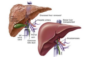 Ce remedii folclorice posibil tratamentul hepatozei hepatice grase listă