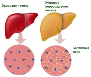 Якими народними засобами можливо лікування жирового гепатозу печінки список