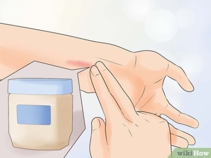 Cum să tratezi o arsură ușoară
