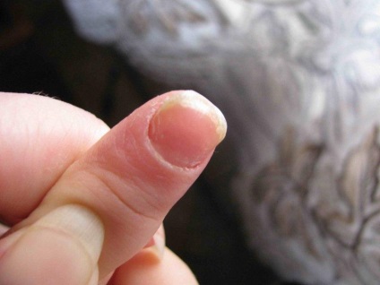Cum se identifică boala prin unghii