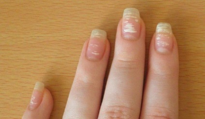 Cum se identifică boala prin unghii