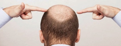 Cum să oprești căderea părului la femei și bărbați
