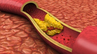 Cum puteți scădea nivelul colesterolului din sânge rapid și eficient