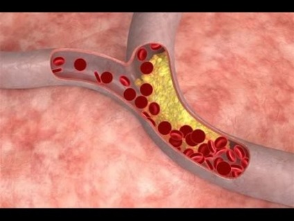 Cum puteți scădea nivelul colesterolului din sânge rapid și eficient