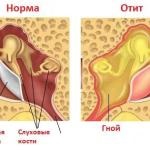 Cum de a vindeca glanda tiroidă, două portocale