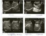 Piatra în ficat - este sau nu (cu poze cu uzi), 6 răspunsuri, 18 comentarii, forum de consultare