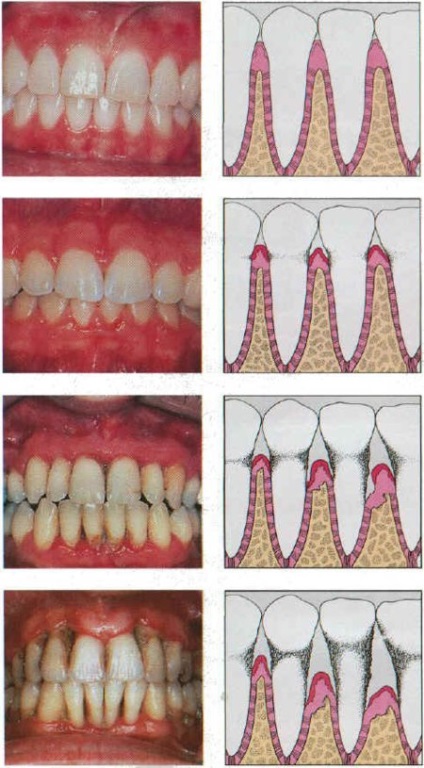 Ce cauzează nerespectarea igienei orale și cum să îngrijești corect dinții, nord dentar