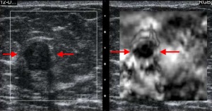 Aplicarea clinică a elastografiei cu ultrasunete
