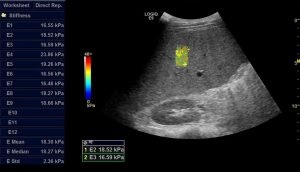 Aplicarea clinică a elastografiei cu ultrasunete