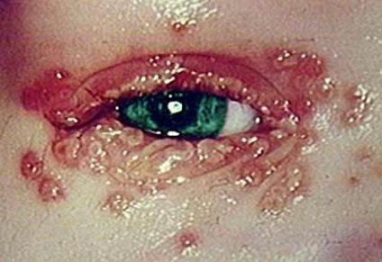 Herpesul labial și tratamentul fotografic al acestuia, simptome