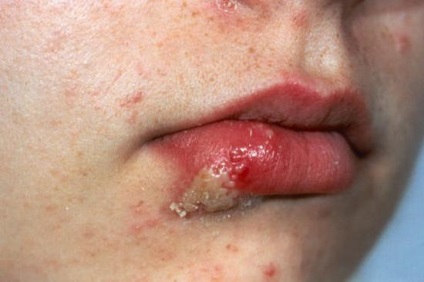 Herpesul labial și tratamentul fotografic al acestuia, simptome