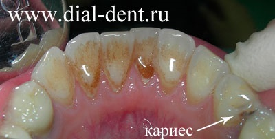 Tratamentul cariilor dentare și curățarea fluxului de aer