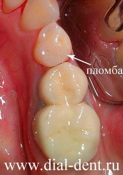 Tratamentul cariilor dentare și curățarea fluxului de aer