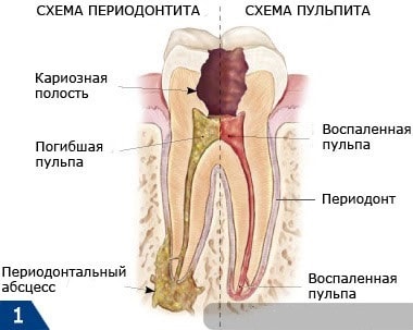 Tratamentul parodontitei, pregătirea, procedurile la medicul dentist și la domiciliu