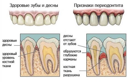 Tratamentul parodontitei, pregătirea, procedurile la medicul dentist și la domiciliu