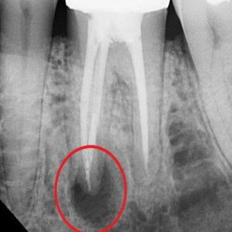 Tratamentul parodontitei, pregătirea, procedurile la medicul dentist și la domiciliu