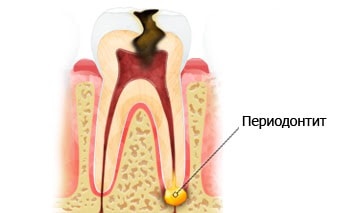periodontális kezelés készítmény, eljárás a fogorvos és otthon