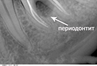 Tratamentul parodontitei, pregătirea, procedurile la medicul dentist și la domiciliu