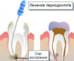 Tratamentul parodontitei, pregătirea, procedurile la medicul dentist și la domiciliu