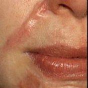 Tratamentul cicatricilor și cicatricilor pe față cu laser, remedii populare la domiciliu - populare despre