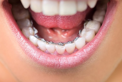 Sistemul lingual acopere sistemele invizibile din interiorul dinților