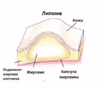 Lipoma a sânului care este, cauze, diagnostic, tratament (inclusiv folclor