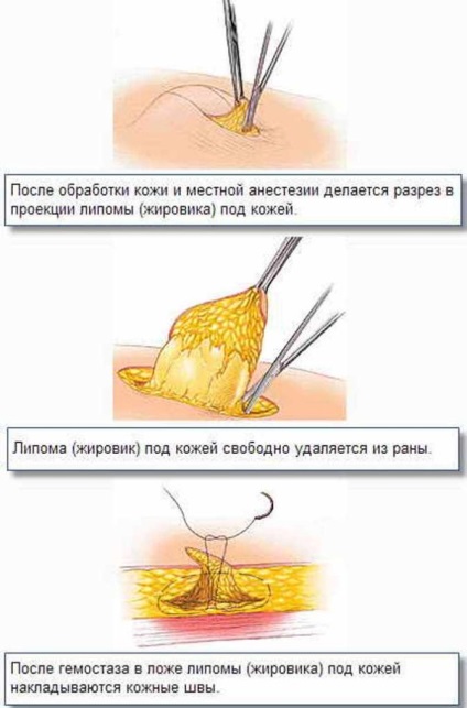 Lipoma a sânului care este, cauze, diagnostic, tratament (inclusiv folclor