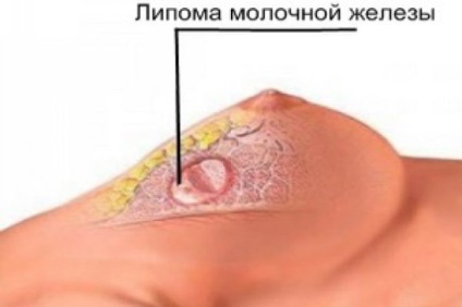 Lipoma a sânului care este, cauze, diagnostic, tratament (inclusiv folclor