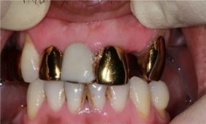 Fém korona a fogak, különösen struktúrák