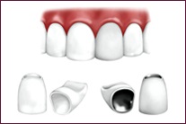 Metal-ceramica dintelui, coroana metalo-ceramica, stomatolog-ortopedist, stomatologie din Izhevsk