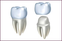 Metal-ceramica dintelui, coroana metalo-ceramica, stomatolog-ortopedist, stomatologie din Izhevsk