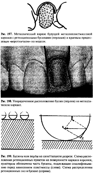 Coroane metal-plastic pe bază de turnare - portal dentar bun, bun