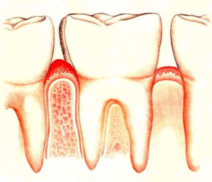 Metode de tratament a gingivitei la domiciliu și la clinica stomatologică