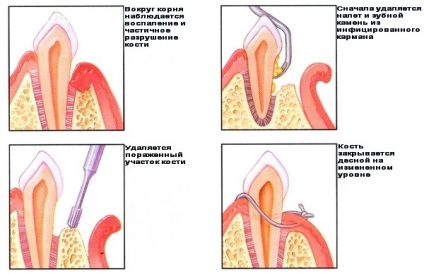 Metode de tratament a gingivitei la domiciliu și la clinica stomatologică