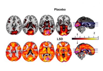 Az emberi agy az LSD-t először az MRI, csak a legjobb értékeléseket az interneten