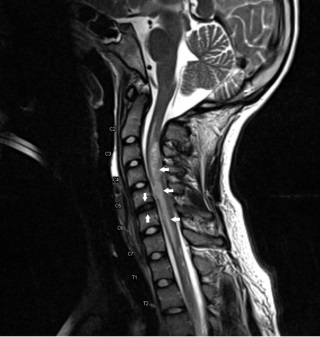 MRI на шийните прешлени - цена, скорост, декодиране, подготовка, противопоказания