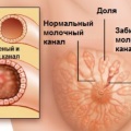 Cauza și tratamentul lunar neregulat