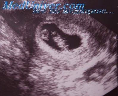 Berendezés ultrahang terhesség első trimeszterében