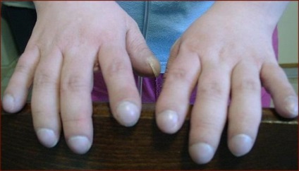 Pericol de boli ale unghiilor în mâini