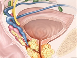 Descrierea momentelor cheie ale terapiei ortomoleculare pentru adenomul de prostată