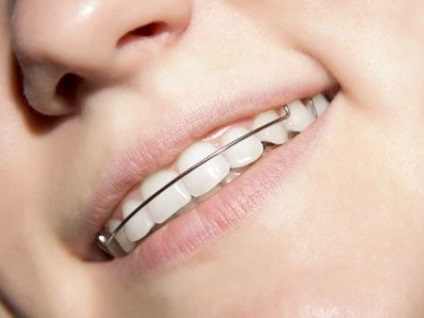 Suporturi ortodontice pe dinți pentru corecția mușcăturii