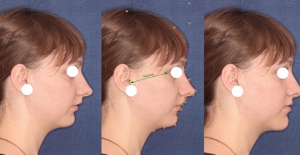 Chirurgie ortognatică - care are nevoie de chirurgie maxilo-facială, rezultate foto