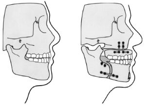 Chirurgie ortognatică - care are nevoie de chirurgie maxilo-facială, rezultate foto