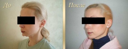 Chirurgie ortognatică - care are nevoie de chirurgie maxilo-facială, rezultate foto